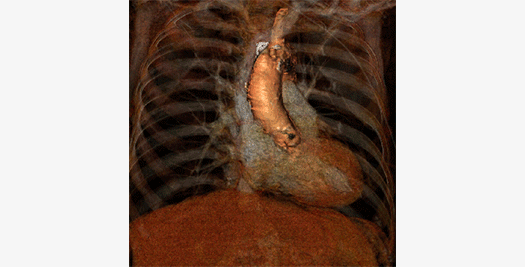 CT-Valve_Aortic-Root-VR-1